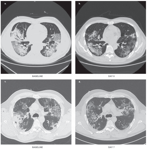 Bevacizumab treatment beneficial for patients with severe COVID-19