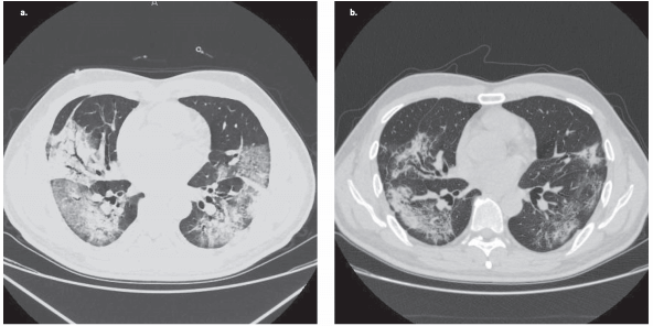 Bevacizumab treatment beneficial for patients with severe COVID-19